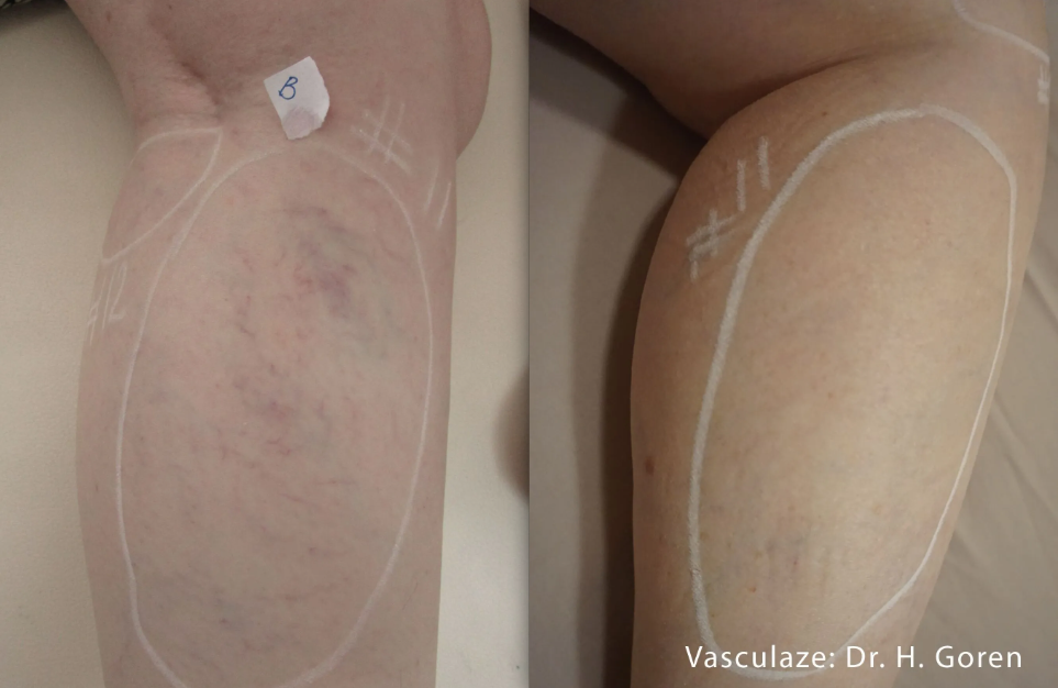 Vasculaze before and after spider vein treatment results at Bespoke Medesthetics Jericho NY